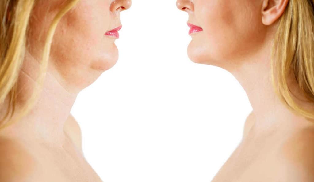 Double Chin treatment Wantage before and after results