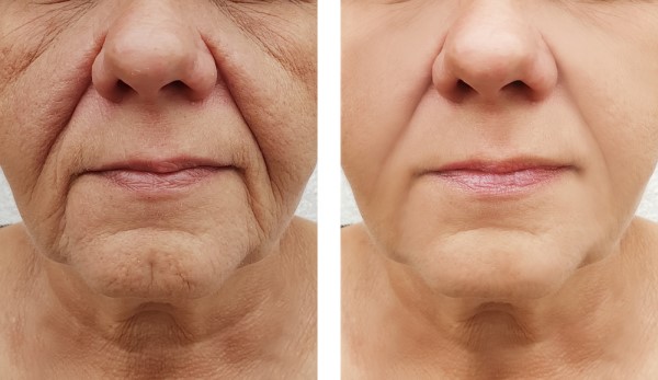 Learn more about Morpheus8 Treatment Wantage today!