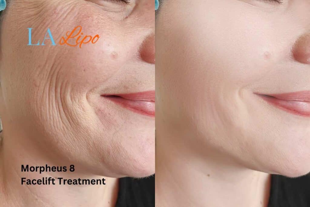 Morpheus8 Treatment Wantage for flawless skin! Call us today!
