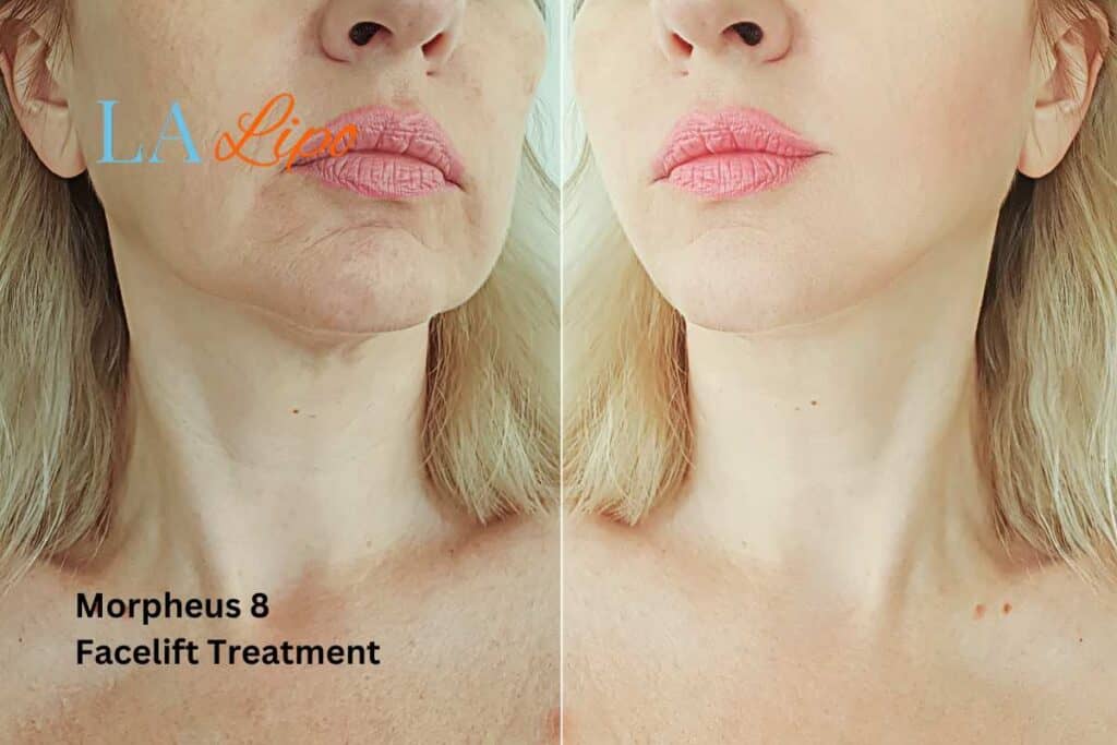 Turn back time with Morpheus8 Treatment Wantage