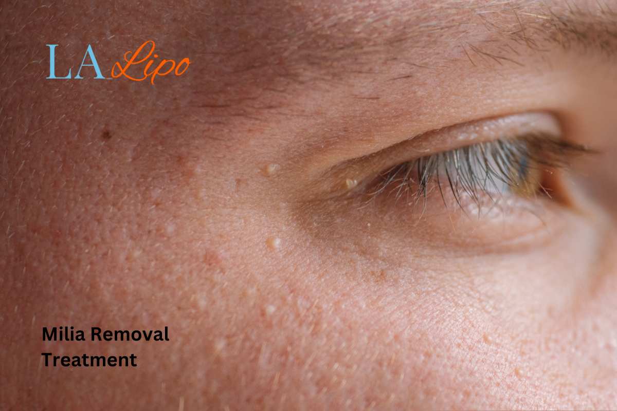 Cryopen Milia Removal: Is It the Easiest and Safest Option Wantage?