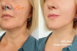 hi-fu for wrinkles Wantage before and after results