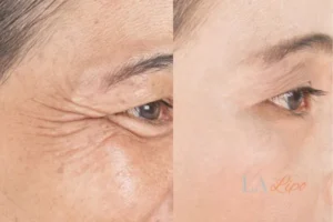 Before and after results of woman - HI-fu wrinkles reduction treatment Wantage