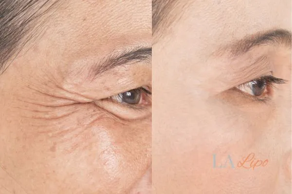 Before and after results of woman - HI-fu wrinkles reduction treatment Wantage