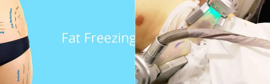 Fat freezing Wantage on multiple areas of the body