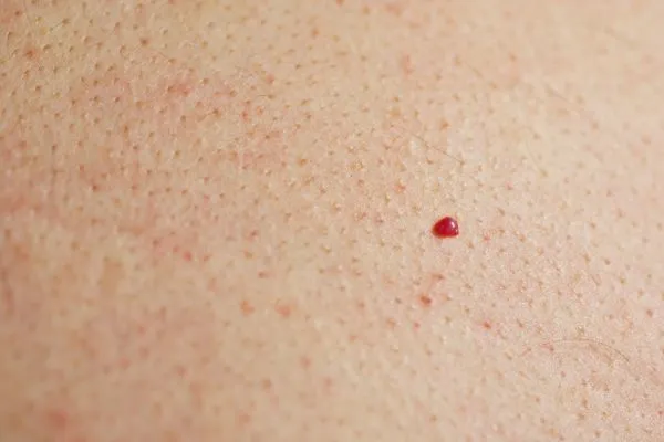 close up of a cherry angioma Wantage