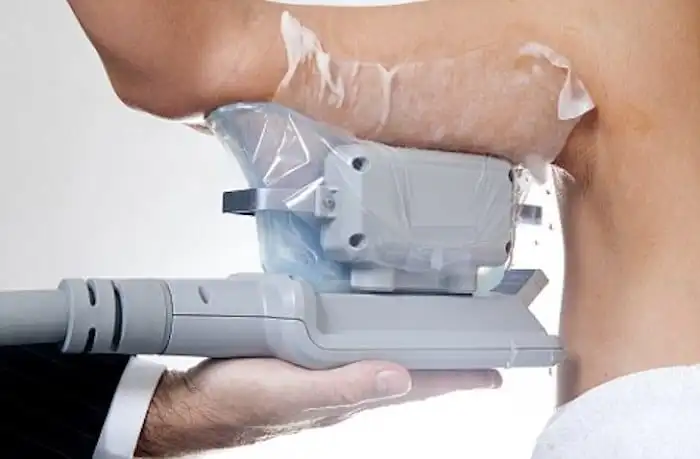 Picture of fat freezing Wantage on the upper arms.
