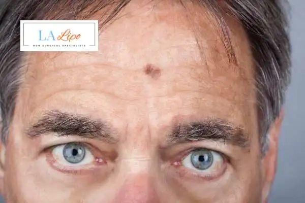 Solar Lentigo Removal Wantage image of man with mark on his forehead