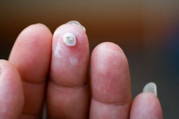 wart on person finger - cryotherapy to treat from LA LIPO Wantage