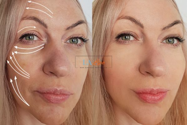 Morpheus 8 results Wantage face lift.