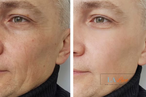 See the amazing results of Morpheus8 Treatment Wantage!