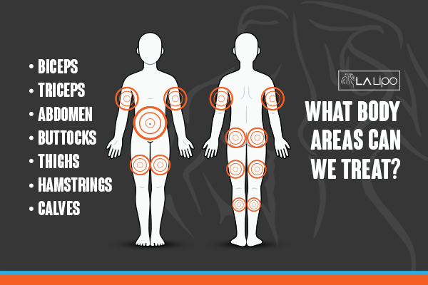 Diagram to show areas you can have LA-EMS Body Sculpting Treatment Wantage