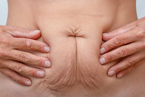 Should I Combine Diastasis Recti Treatment with Body Contouring for Better Results Wantage?