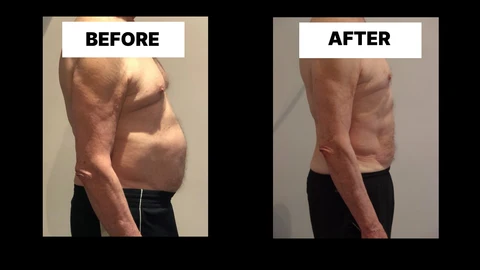 What Symptoms Can Diastasis Recti Cause in Men? Weak Core, Back Pain and Poor Posture Wantage